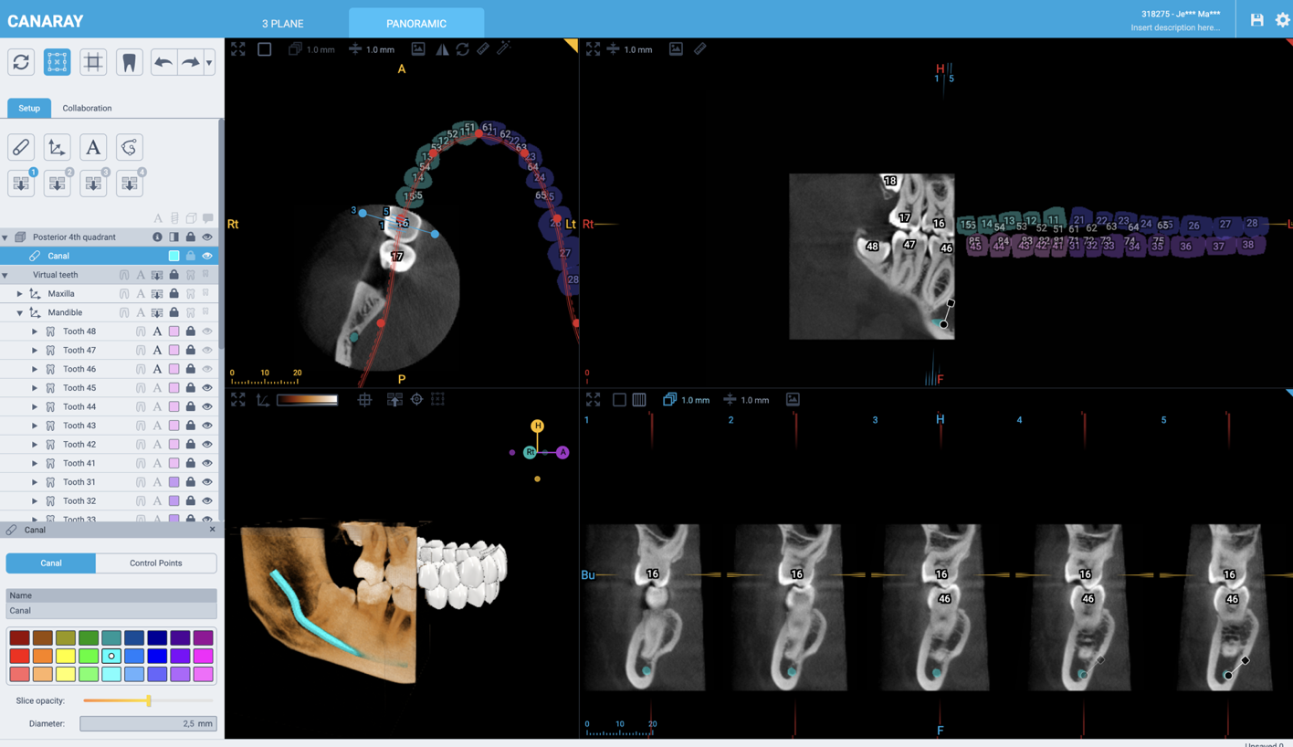 Voxel — Synphonyte 3D dental imaging software with custom nerve-canal geometry